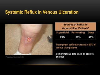 Systemic Reflux in Venous Ulceration
Incompetent perforators found in 63% of
venous ulcer patients
Comprehensive care treats all sources
of refluxPhotos courtesy of Steven A. Kaufman, MD.
Sources of Reflux in
Venous Ulcer Patients8
Superficial Perforating Deep
79% 63% 50%
 