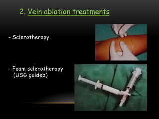 - Sclerotherapy
- Foam sclerotherapy
(USG guided)
2. Vein ablation treatments
 