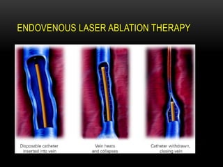 ENDOVENOUS LASER ABLATION THERAPY
 