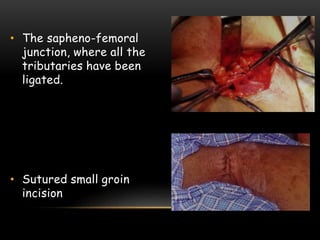 • The sapheno-femoral
junction, where all the
tributaries have been
ligated.
• Sutured small groin
incision
 