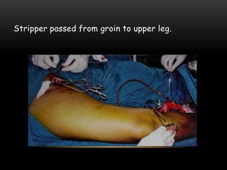Stripper passed from groin to upper leg.
 