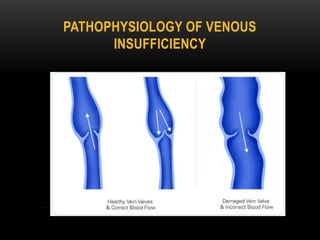 PATHOPHYSIOLOGY OF VENOUS
INSUFFICIENCY
 