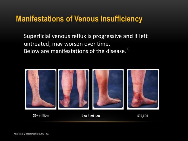 Chronic Superficial Venous insufficiency