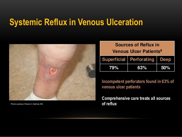 Chronic Superficial Venous insufficiency