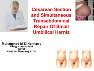 Cesarean Section
and Simultaneous
Transabdominal
Repair Of Small
Umbilical Hernia
Muhammad M El Hennawy
Ob/gyn consultant
Egypt
www.mmhennawy.co.nr
 