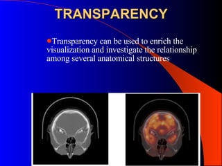 TRANSPARENCY Transparency can be used to enrich the visualization and investigate the relationship among several anatomical structures  