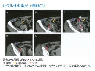 虫垂炎をさがせ
