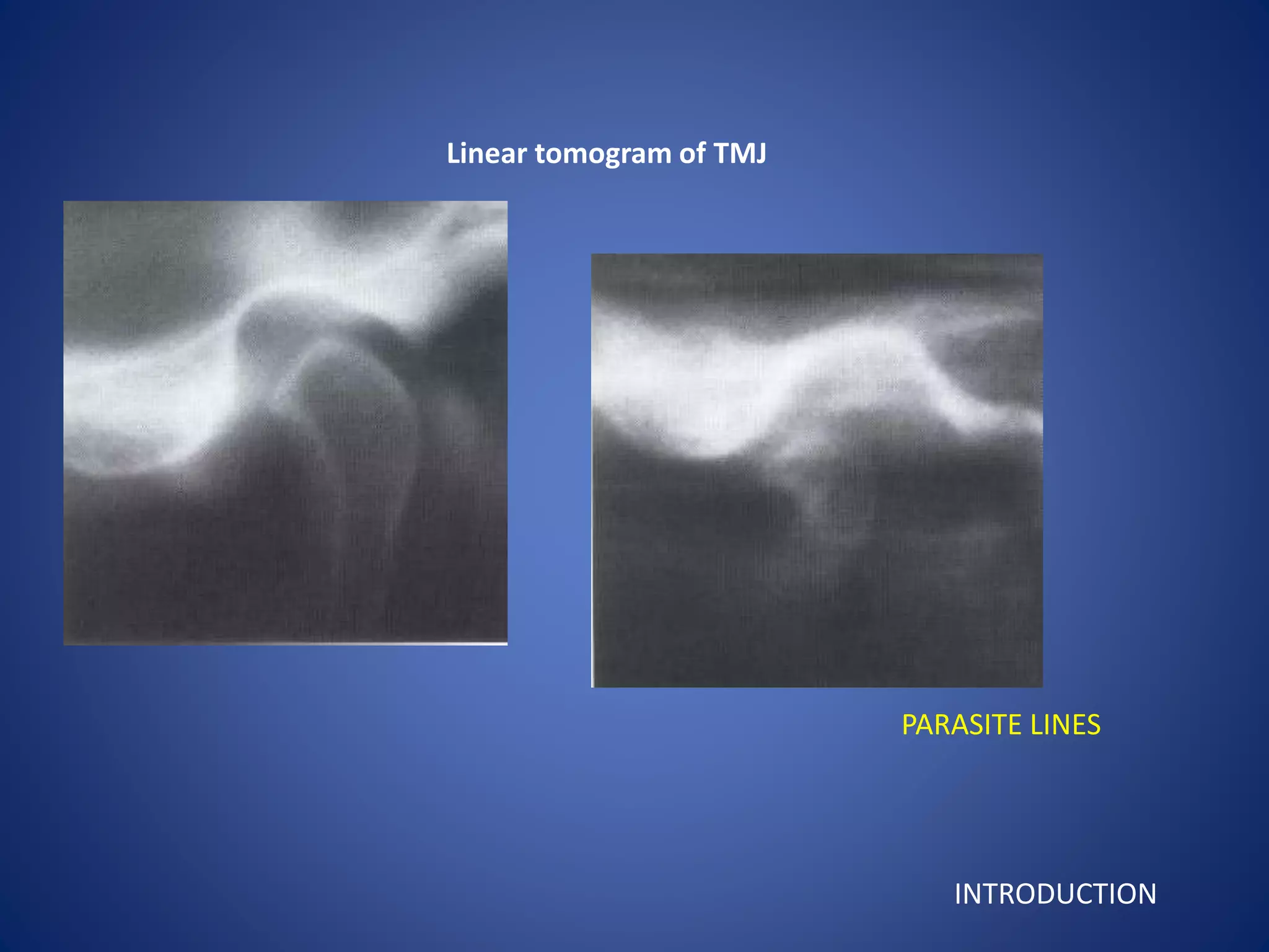 Linear tomogram of TMJ
PARASITE LINES
INTRODUCTION
 