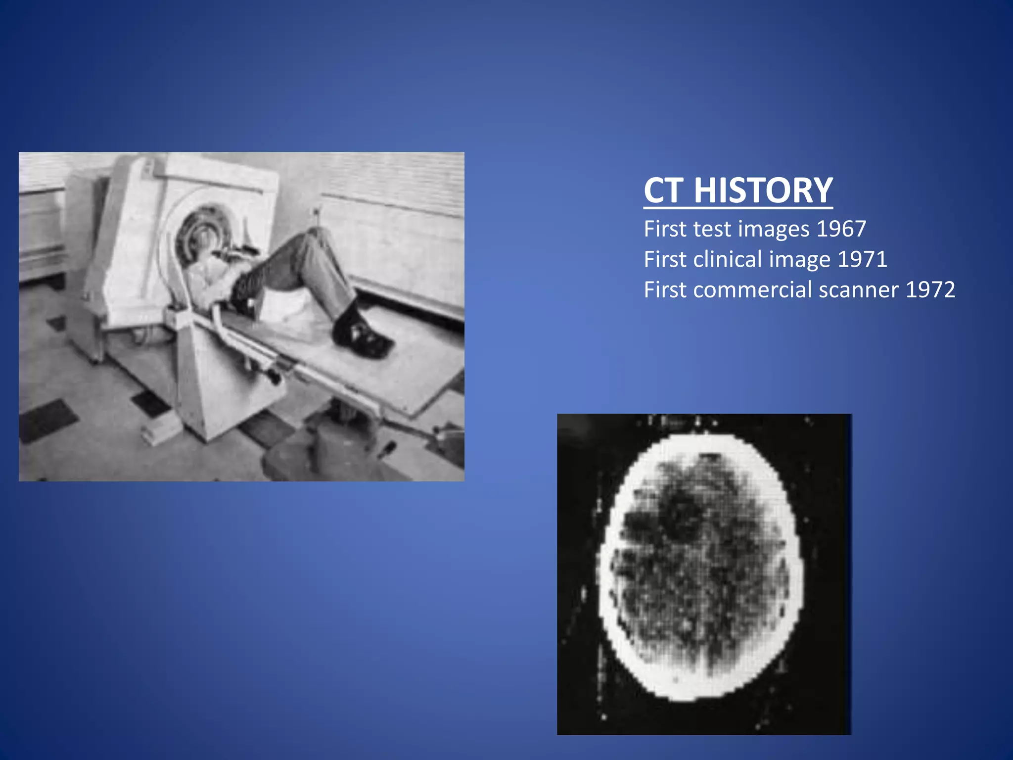 CT HISTORY
First test images 1967
First clinical image 1971
First commercial scanner 1972
 