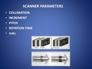 SCANNER PARAMETERS
• COLLIMATION
• INCREMENT
• PITCH
• ROTATION TIME
• mAs
 