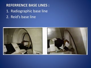 REFERRENCE BASE LINES :
1. Radiographic base line
2. Reid’s base line
 