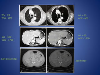 Soft tissue filter
Bone filter
WL – 50
WW - 200
WL – 50
WW - 400
WL – 600
WW - 1700
WL – 60
WW - 1700
 