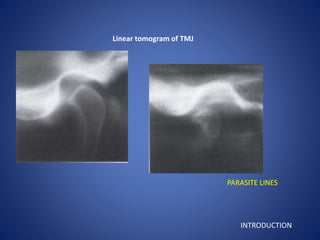 Linear tomogram of TMJ
PARASITE LINES
INTRODUCTION
 