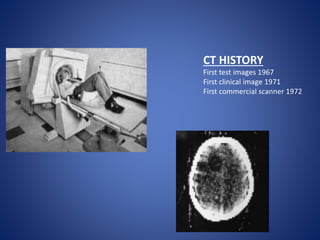CT HISTORY
First test images 1967
First clinical image 1971
First commercial scanner 1972
 