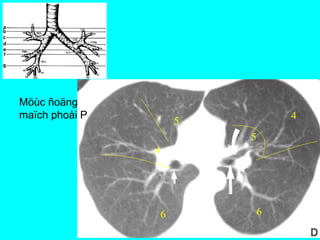 Möùc ñoäng
maïch phoåi P
66
5
4
5
4
 