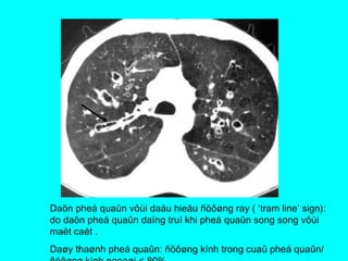 Daõn pheá quaûn vôùi daáu hieäu ñöôøng ray ( ‘tram line’ sign):
do daõn pheá quaûn daïng truï khi pheá quaûn song song vôùi
maët caét .
Daøy thaønh pheá quaûn: ñöôøng kính trong cuaû pheá quaûn/
 