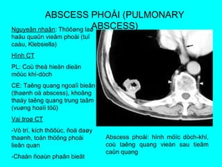 ABSCESS PHOÅI (PULMONARY
ABSCESS)Nguyeân nhaân: Thöôøng laø
haäu quaûn vieâm phoåi (tuï
caàu, Klebsiella)
Hình CT
PL: Coù theå hieän dieän
möùc khí-dòch
CE: Taêng quang ngoaïi bieân
(thaønh oå abscess), khoâng
thaáy taêng quang trung taâm
(vuøng hoaïi töû)
Vai troø CT
-Vò trí, kích thöôùc, ñoä daøy
thaønh, toån thöông phoåi
lieân quan
-Chaån ñoaùn phaân bieät
Abscess phoåi: hình möïc dòch-khí,
coù taêng quang vieàn sau tieâm
caûn quang
 