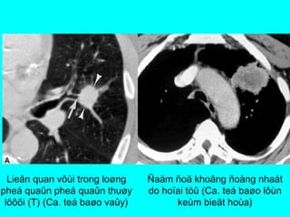 Ñaäm ñoä khoâng ñoàng nhaát
do hoïai töû (Ca. teá baøo lôùn
keùm bieät hoùa)
Lieân quan vôùi trong loøng
pheá quaûn pheá quaûn thuøy
löôõi (T) (Ca. teá baøo vaûy)
 
