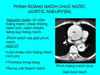 PHÌNH ÑOÄNG MAÏCH CHUÛ NGÖÏC
(AORTIC ANEURYSM)
-Nguyeân nhaân: Xô vöõa
ñoäng maïch, chaán thöông,
baåm sinh, vieâm nhieãm,
taêng aùp ñoäng maïch..
-Phình maïch vaø giaû phình
maïch
-Hình CT
+Lôùn khaåu kính ñoäng maïch
(>4-5 cm)
+Thrombus trong loøng
+Ñoùng voâi thaønh maïch
Phình ñoäng maïch chuû
Giaû boùc taùch
 