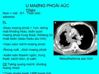 U MAØNG PHOÅI AÙC
TÍNH
Nam > nöõ : 5/1. Tieàn söû:
asbestos
PL
-Daøy maøng phoåi > 1cm, daïng
noát khoâng ñeàu, lieân quan
maøng phoåi trung thaát, thöôøng ôû
moät beân (daáu hieäu aùc tính)
-Vaøo caùc raõnh maøng phoåi
-Ñoùng voâi , dòch maøng phoåi
-Xaâm laán thaønh ngöïc, trung
thaát, haïch lôùn, di caên
CE:Taêng quang maïnh, khoâng
ñoàng nhaát
Mesothelioma aùc tính
 