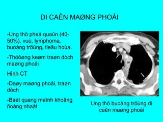 DI CAÊN MAØNG PHOÅI
-Ung thö pheá quaûn (40-
50%), vuù, lymphoma,
buoàng tröùng, tieâu hoùa.
-Thöôøng keøm traøn dòch
maøng phoåi
Hình CT
-Daøy maøng phoåi, traøn
dòch
-Baét quang maïnh khoâng
ñoàng nhaát
Ung thö buoàng tröùng di
caên maøng phoåi
 