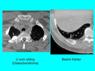 U suïn xöông
(Osteochondroma)
Beänh Kahler
 