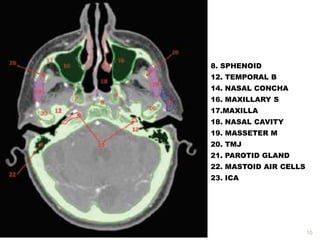 8. SPHENOID
12. TEMPORAL B
14. NASAL CONCHA
16. MAXILLARY S
17.MAXILLA
18. NASAL CAVITY
19. MASSETER M
20. TMJ
21. PAROTID GLAND
22. MASTOID AIR CELLS
23. ICA
10
 