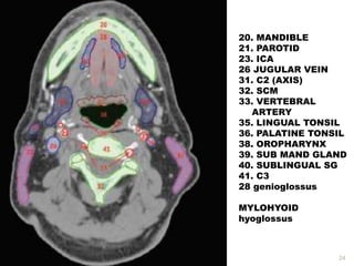 24
20. MANDIBLE
21. PAROTID
23. ICA
26 JUGULAR VEIN
31. C2 (AXIS)
32. SCM
33. VERTEBRAL
ARTERY
35. LINGUAL TONSIL
36. PALATINE TONSIL
38. OROPHARYNX
39. SUB MAND GLAND
40. SUBLINGUAL SG
41. C3
28 genioglossus
MYLOHYOID
hyoglossus
 