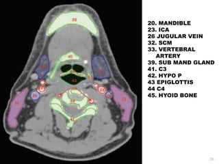 29
20. MANDIBLE
23. ICA
26 JUGULAR VEIN
32. SCM
33. VERTEBRAL
ARTERY
39. SUB MAND GLAND
41. C3
42. HYPO P
43 EPIGLOTTIS
44 C4
45. HYOID BONE
 