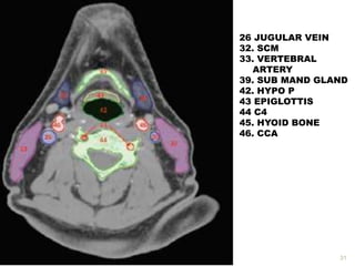 31
26 JUGULAR VEIN
32. SCM
33. VERTEBRAL
ARTERY
39. SUB MAND GLAND
42. HYPO P
43 EPIGLOTTIS
44 C4
45. HYOID BONE
46. CCA
 