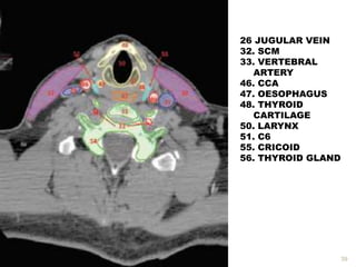 39
26 JUGULAR VEIN
32. SCM
33. VERTEBRAL
ARTERY
46. CCA
47. OESOPHAGUS
48. THYROID
CARTILAGE
50. LARYNX
51. C6
55. CRICOID
56. THYROID GLAND
 