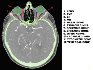 1. LENS
2. EYE
3. LR
4. MR
5. NASAL BONE
6. ETHMOID SINUS
7. SPHENOID SINUS
8. SPHENOID BONE
9. OPTIC NERVE
10.LACRIMALGLAND
11.ZYGOMATIC BONE
12.TEMPORAL BONE
8
 