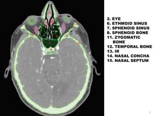 2. EYE
6. ETHMOID SINUS
7. SPHENOID SINUS
8. SPHENOID BONE
11. ZYGOMATIC
BONE
12. TEMPORAL BONE
13. IR
14. NASAL CONCHA
15. NASAL SEPTUM
9
 