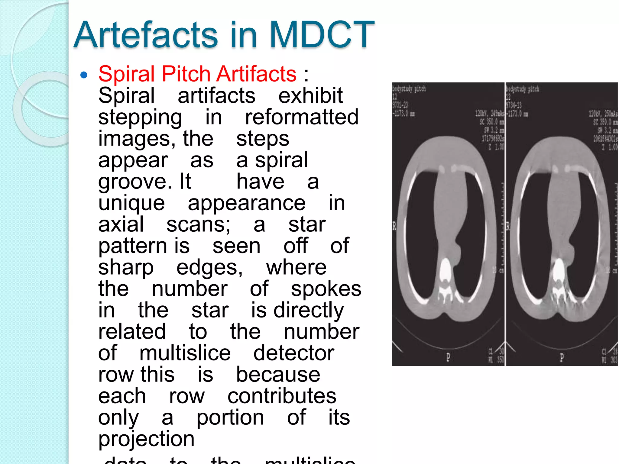 Artefacts in MDCT
 Spiral Pitch Artifacts :
Spiral artifacts exhibit
stepping in reformatted
images, the steps
appear as a spiral
groove. It have a
unique appearance in
axial scans; a star
pattern is seen off of
sharp edges, where
the number of spokes
in the star is directly
related to the number
of multislice detector
row this is because
each row contributes
only a portion of its
projection
 