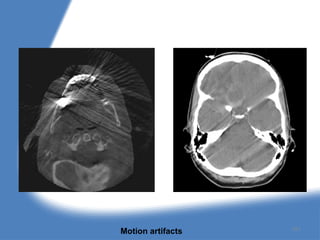 Motion artifacts 151
 
