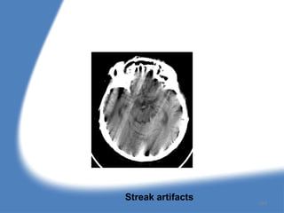 Streak artifacts
154
 