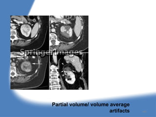 Partial volume/ volume average
artifacts 160
 