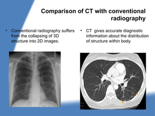 Comparison of CT with conventional
radiography
• Conventional radiography suffers
from the collapsing of 3D
structure into 2D images.
• CT gives accurate diagnostic
information about the distribution
of structure within body.
9
 