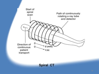 Spiral CT
96
 