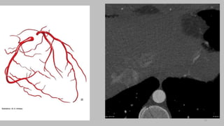 Ct   coronary  angiography edited 1st