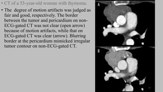 Ct   coronary  angiography edited 1st
