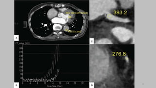 Ct   coronary  angiography edited 1st