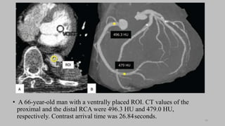 Ct   coronary  angiography edited 1st