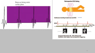 Ct   coronary  angiography edited 1st