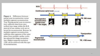 Ct   coronary  angiography edited 1st