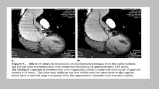 Ct   coronary  angiography edited 1st