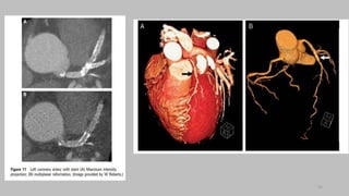 Ct   coronary  angiography edited 1st