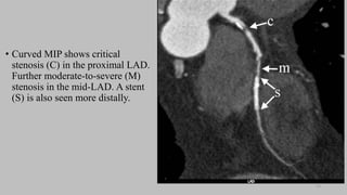 Ct   coronary  angiography edited 1st