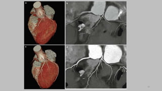 Ct   coronary  angiography edited 1st