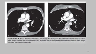 Ct   coronary  angiography edited 1st